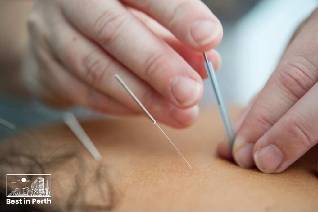 Top 5 Acupuncturists in Perth